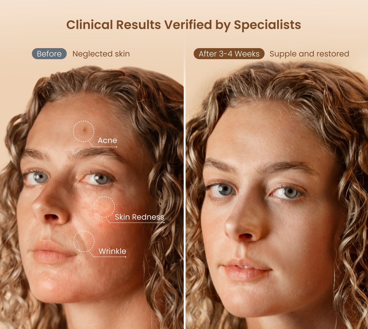 Artemis LED Light Therapy Mask